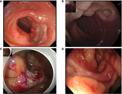 Case report: Refractory intestinal Behçet’s syndrome successfully treated with tofacitinib: A report of four cases